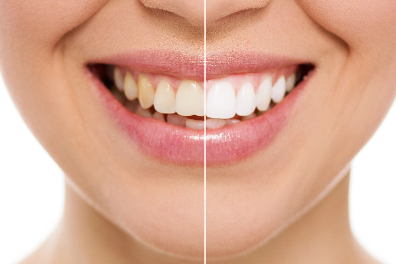 Augusztin Medical - fogfehérítés